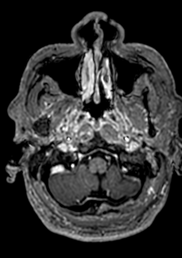 Accessory middle cerebral artery (Radiopaedia 73114-83828 Axial T1 C+ 174).jpg