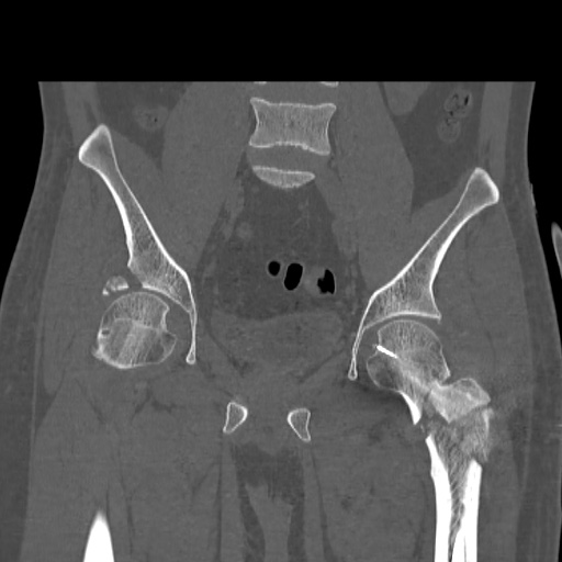 File:Acetabular and ilial fractures (Radiopaedia 59084-66378 Coronal bone window 25).jpg