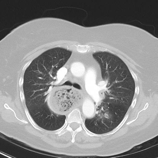 File:Achalasia (Radiopaedia 47147-51685 Axial lung window 20).png