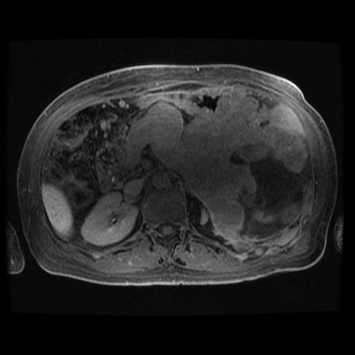 Acinar cell carcinoma of the pancreas (Radiopaedia 75442-86668 Axial late phase (~30 mins) 54).jpg