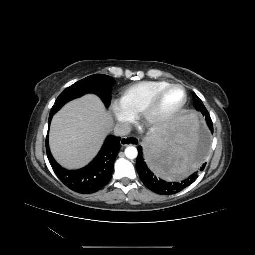 File:Acinar cell carcinoma of the pancreas (Radiopaedia 75442-86669 Axial C+ portal venous phase 10).jpg