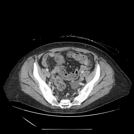 Acinar cell carcinoma of the pancreas (Radiopaedia 75442-86669 Axial C+ portal venous phase 119).jpg