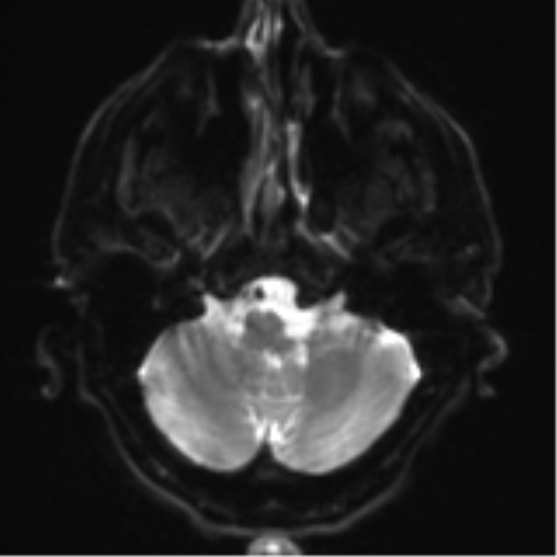Acoustic schwannoma (Radiopaedia 55729-62281 E 3).png