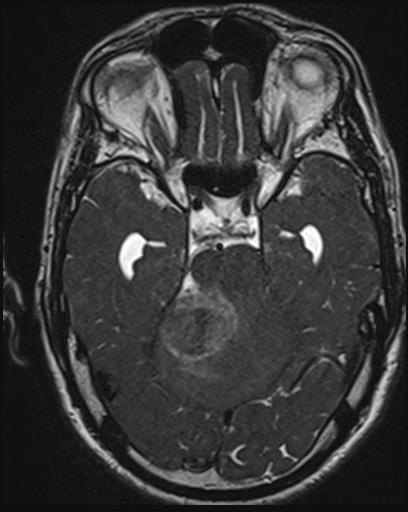 Acoustic schwannoma - probable (Radiopaedia 20386-20292 Axial T1 53).jpg