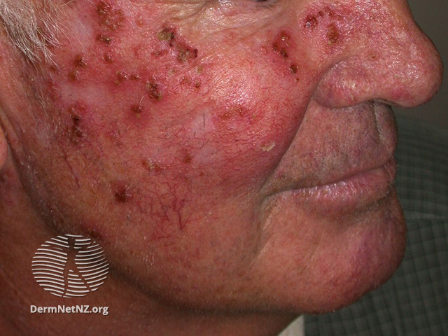 File:Actinic Keratoses treated with imiquimod (DermNet NZ lesions-ak-imiquimod-3733).jpg