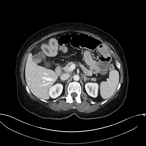 Active Crohn disease (Radiopaedia 59394-66750 Axial C+ portal venous phase 24).jpg