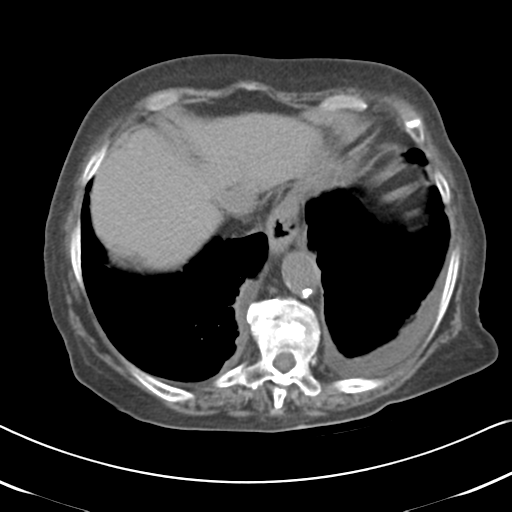 File:Active bleeding from duodenal ulcer with embolization (Radiopaedia 34216-35481 Axial non-contrast 13).png
