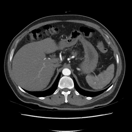 File:Active colonic bleed on CT (Radiopaedia 49765-55025 Axial C+ arterial phase 21).jpg