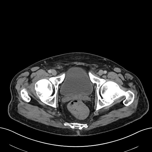 File:Active lower gastrointestinal bleeding - diverticular (Radiopaedia 61203-69106 Axial C+ portal venous phase 121).jpg