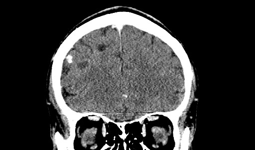 File:Active neurocysticercosis before and after therapy (Radiopaedia 71710-82099 Coronal C+ delayed 23).jpg