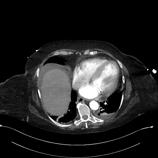 Active renal extravasation with large subcapsular and retroperitoneal hemorrhage (Radiopaedia 60975-68796 Axial C+ arterial phase 20).jpg