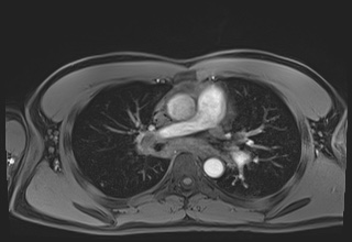 File:Active right ventricular cardiac sarcoidosis (Radiopaedia 55596-62100 Axial Post contrast Dixon 27).jpg