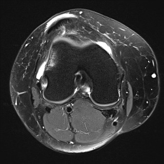 File:Acute-on-chronic transient lateral patellar dislocation with trochlear dysplasia (Radiopaedia 84099-99349 Axial PD fat sat 18).jpg
