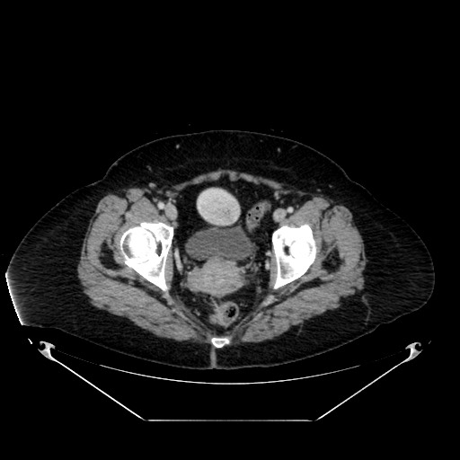 File:Acute appendicitis, heterotaxy syndrome (Radiopaedia 66884-76202 Axial 86).jpg
