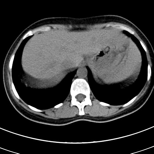 Acute appendicitis (Radiopaedia 30261-30888 Axial non-contrast 3).jpg