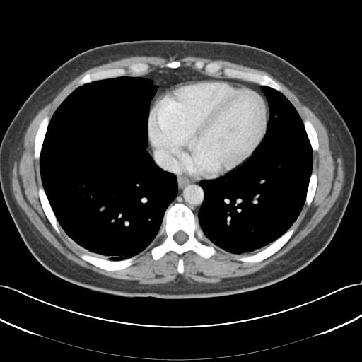 File:Acute appendicitis (Radiopaedia 30297-30934 Axial C+ portal venous phase 3).jpg