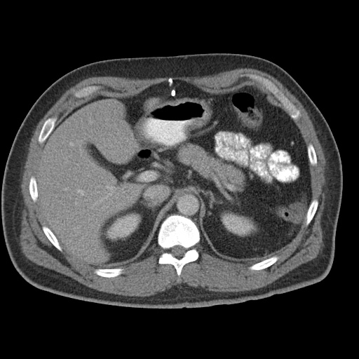 Acute appendicitis (Radiopaedia 48511-53463 Axial C+ portal venous phase 28).jpg