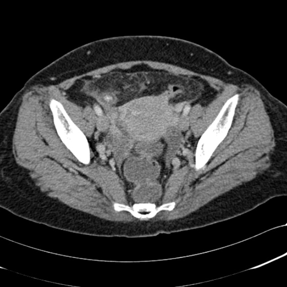 Acute appendicitis (Radiopaedia 48792-53822 Axial C+ portal venous phase 98).jpg