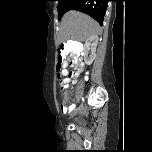 File:Acute appendicitis (Radiopaedia 52672-58589 Sagittal C+ arterial phase 38).jpg