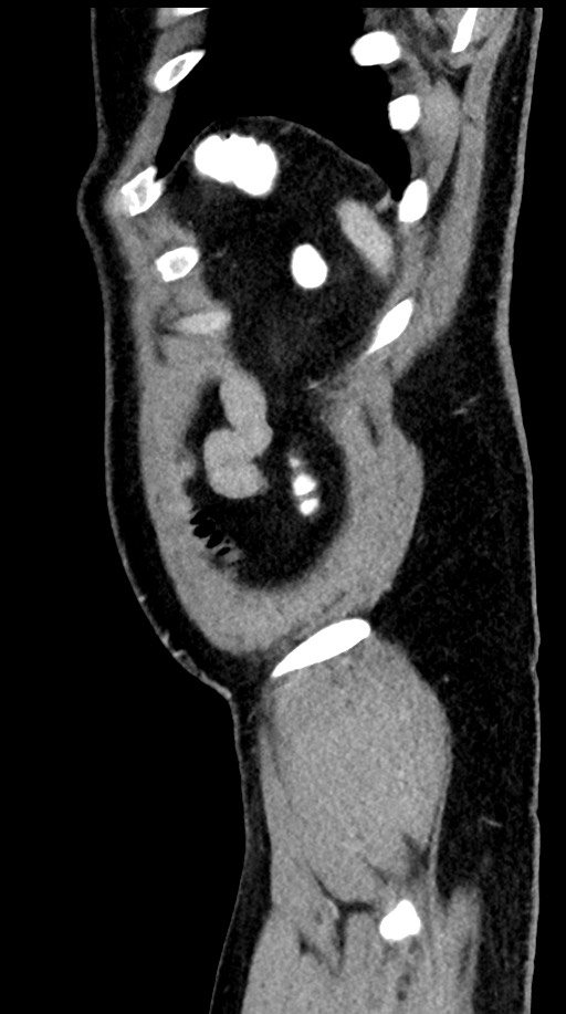 Acute appendicitis (Radiopaedia 77016-88960 Sagittal C+ portal venous phase 12).jpg