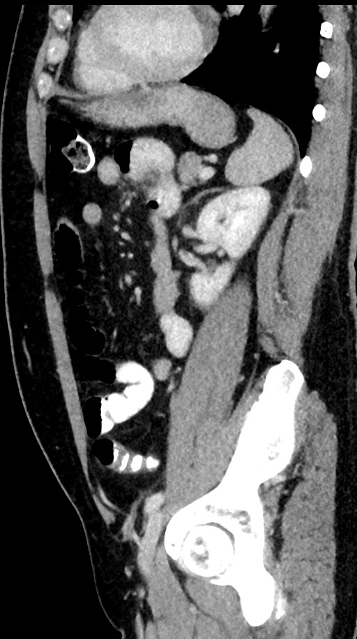 Acute appendicitis (Radiopaedia 77016-88960 Sagittal C+ portal venous phase 39).jpg