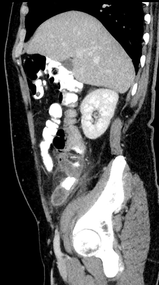 Acute appendicitis (Radiopaedia 77016-88960 Sagittal C+ portal venous phase 83).jpg