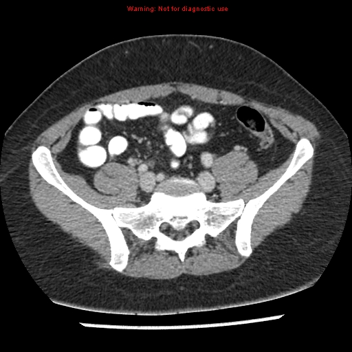 File:Acute appendicitis (Radiopaedia 7966-8812 C+ portal venous phase 37).jpg