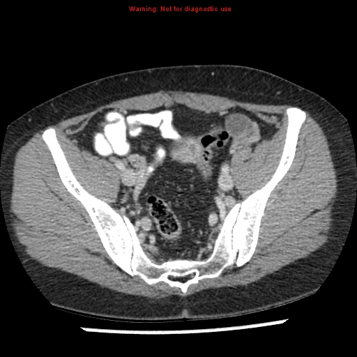 File:Acute appendicitis (Radiopaedia 7966-8812 C+ portal venous phase 43).jpg