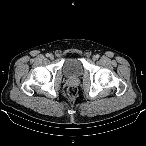 Acute appendicitis (Radiopaedia 84780-100240 Axial C+ portal venous phase 108).jpg