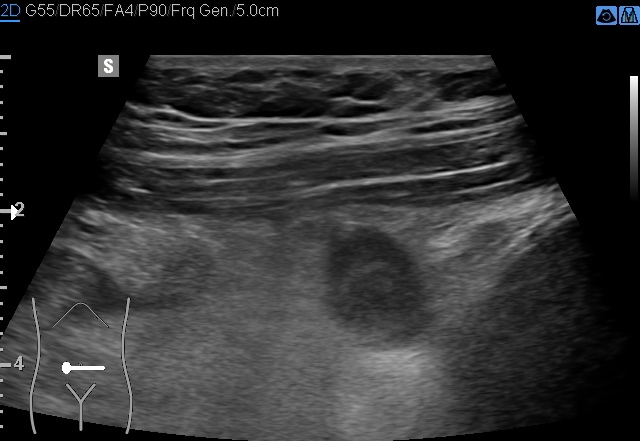 File:Acute appendicitis (Radiopaedia 85193-100745 D 190).jpg