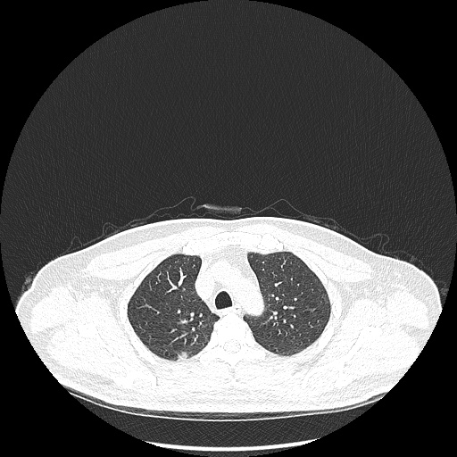 Acute appendicitis and COVID 19 pneumonia (Radiopaedia 76604-88380 Axial lung window 15).jpg