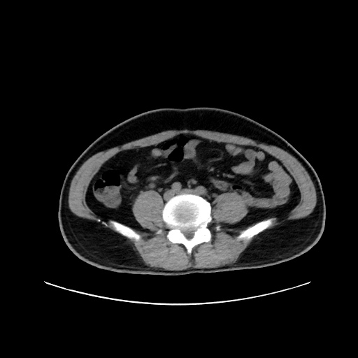 File:Acute appendicitis and COVID 19 pneumonia (Radiopaedia 76604-88380 Axial non-contrast 89).jpg