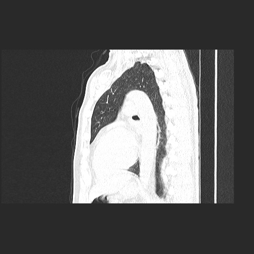 Acute appendicitis and COVID 19 pneumonia (Radiopaedia 76604-88380 Sagittal lung window 60).jpg