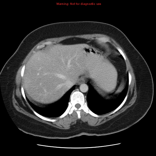 Acute appendicitis complicated by ovarian vein thrombophlebitis (Radiopaedia 16172-15851 Axial C+ portal venous phase 19).jpg