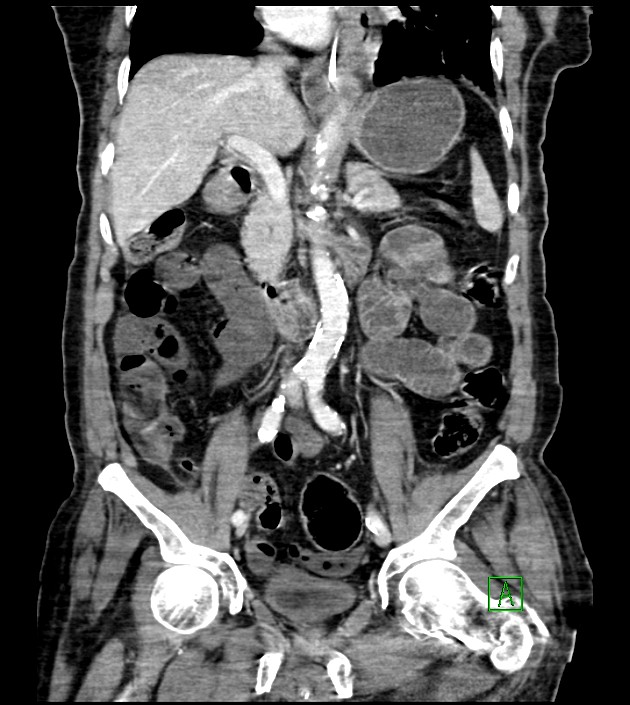 Acute arterial mesenteric ischemia (Radiopaedia 78238-90828 Coronal C+ portal venous phase 50).jpg