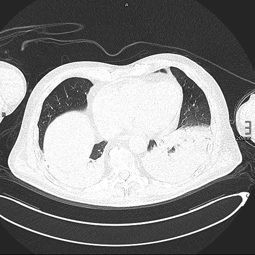 File:Acute aspiration pneumonitis (Radiopaedia 55642-62166 Axial lung window 114).jpg