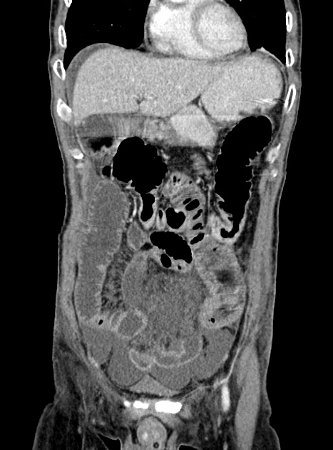 Acute bowel ischemia (Radiopaedia 87695-104114 Coronal C+ portal venous phase 132).jpg