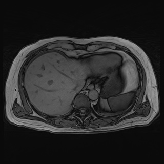Acute cholecystitis (Radiopaedia 72392-82923 Axial T1 out-of-phase 28).jpg