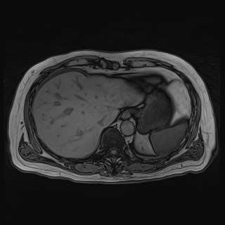 File:Acute cholecystitis (Radiopaedia 72392-82923 Axial T1 out-of-phase 31).jpg