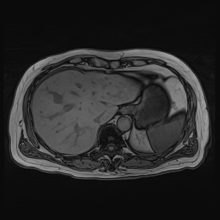 File:Acute cholecystitis (Radiopaedia 72392-82923 Axial T1 out-of-phase 33).jpg