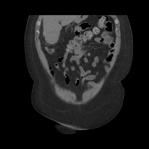 File:Acute cholecystitis with tensile fundus sign (Radiopaedia 71394-81723 Coronal non-contrast 38).jpg