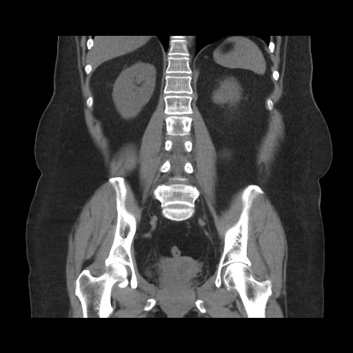 Acute cholecystitis with tensile fundus sign (Radiopaedia 71394-81723 Coronal non-contrast 83).jpg