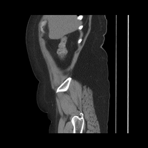 File:Acute cholecystitis with tensile fundus sign (Radiopaedia 71394-81723 Sagittal non-contrast 42).jpg