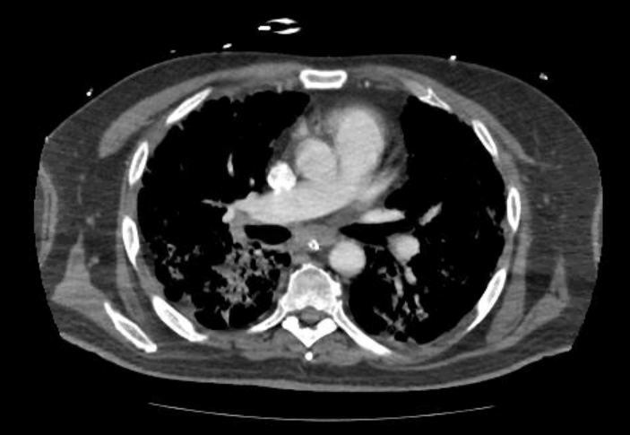 Acute cor pulmonale (ultrasound) (Radiopaedia 83508-98818 Axial C+ CTPA 36).jpg