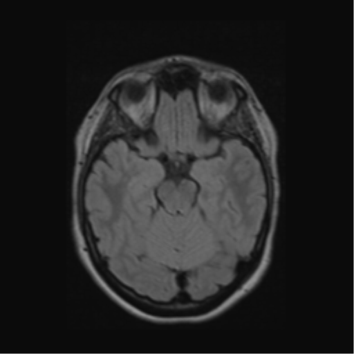 Acute disseminated encephalomyelitis (ADEM) (Radiopaedia 38073-40065 Axial FLAIR 22).png