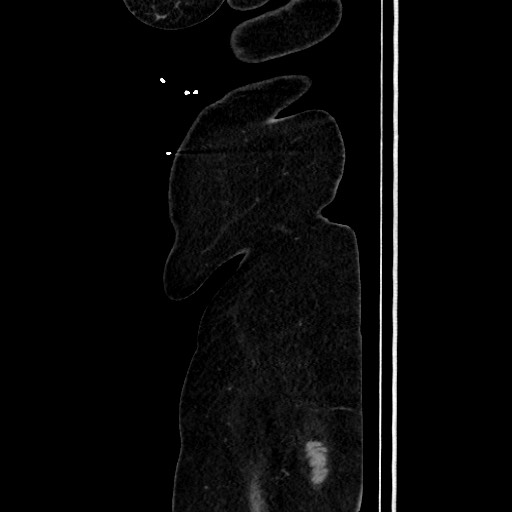 Acute diverticulitis - transverse colon (Radiopaedia 87063-103327 Sagittal C+ portal venous phase 213).jpg