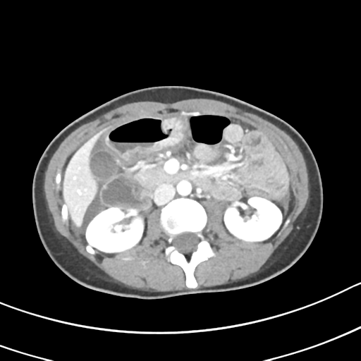 Acute gangrenous appendicitis with perforation (Radiopaedia 40152-42662 Axial C+ portal venous phase 28).png