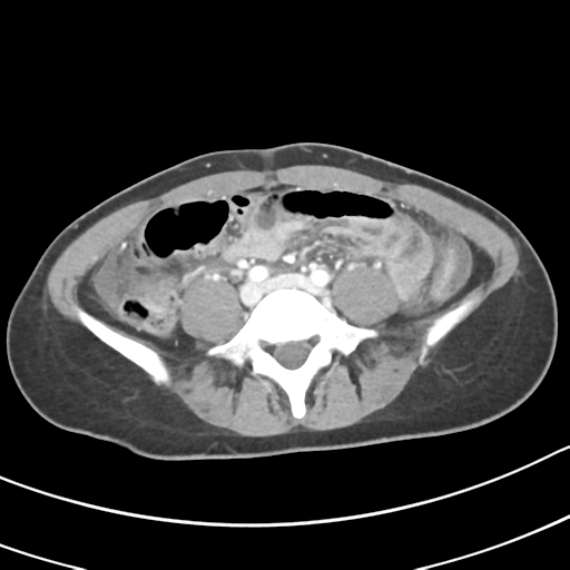 Acute gangrenous appendicitis with perforation (Radiopaedia 40152-42662 Axial C+ portal venous phase 45).png