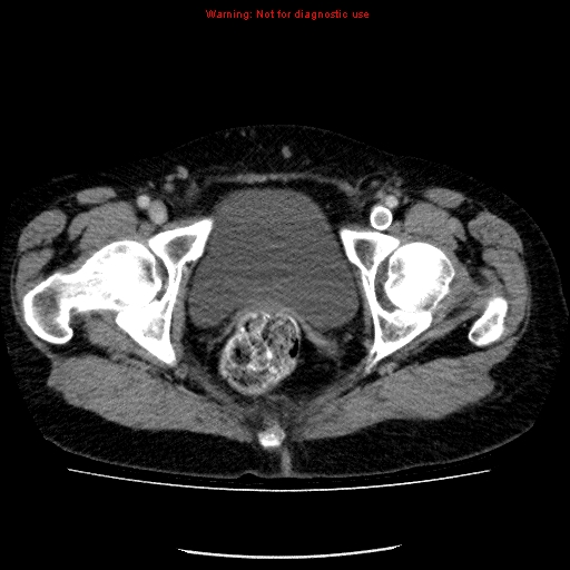 File:Acute gangrenous cholecystitis (Radiopaedia 10123-10661 Axial C+ portal venous phase 98).jpg