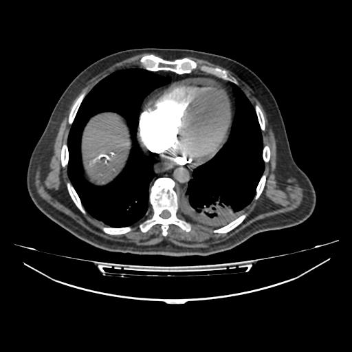 Acute heart failure (CT) (Radiopaedia 79835-93075 Axial C+ arterial phase 42).jpg